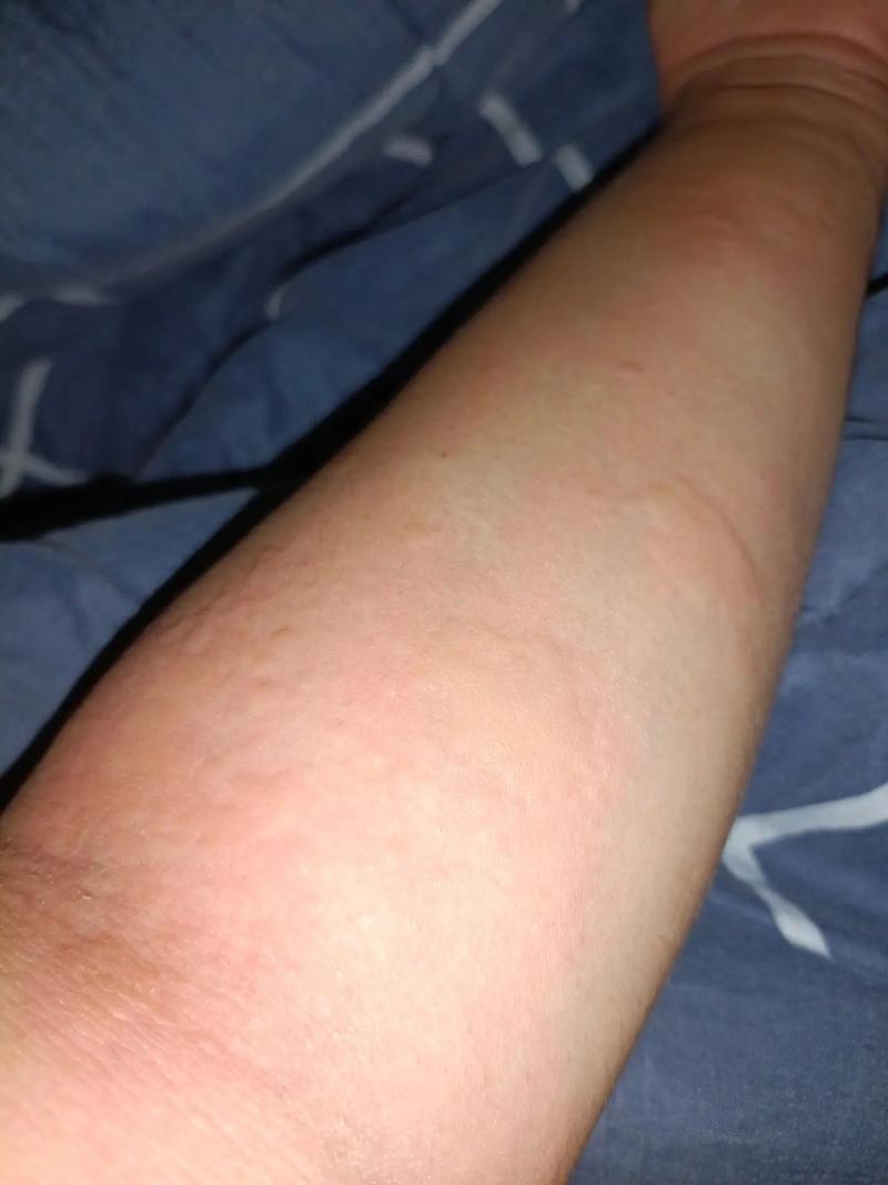 风水疙瘩会自己消失，还是需要采取措施才嫩去除呢？