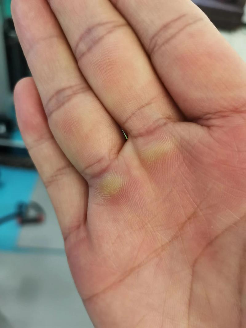 为什么我的手总是容易起茧子，这是命格使然吗？