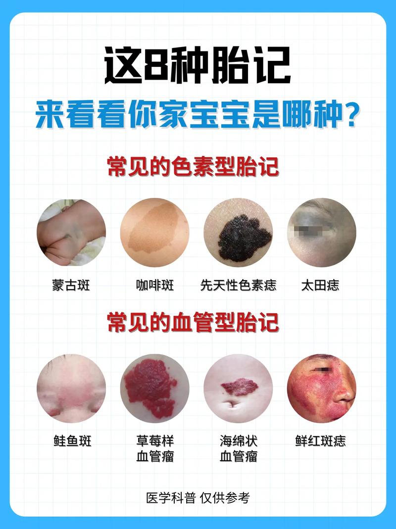男孩左脸胎记预示着怎样的命运或福气？