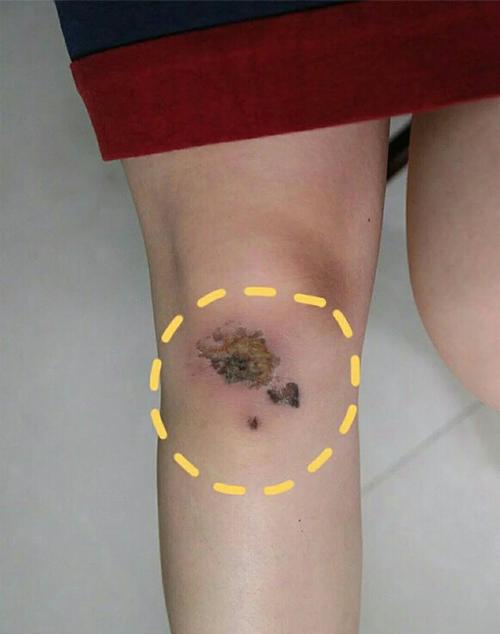 腿上膝盖疤痕会影响命格吗？这是否会改变我的命运走向？