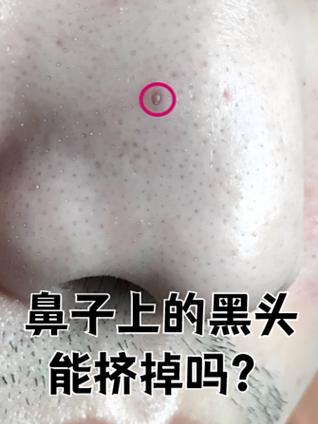 鼻子黑头是否会对家居风水产生不良影响？