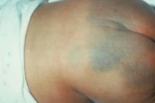 腿上爱心胎记命运如何，胎记位置对人生有何影响？