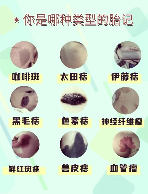 眼睛周围胎记代表什么命运？贵子胎记出现在六个部位有何特殊含义？