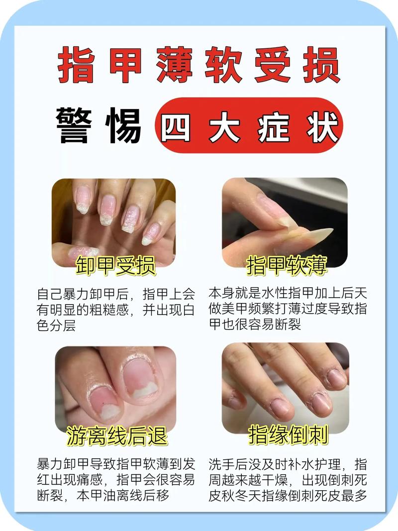 指甲软的人命运如何，能否通过某种方式改善？