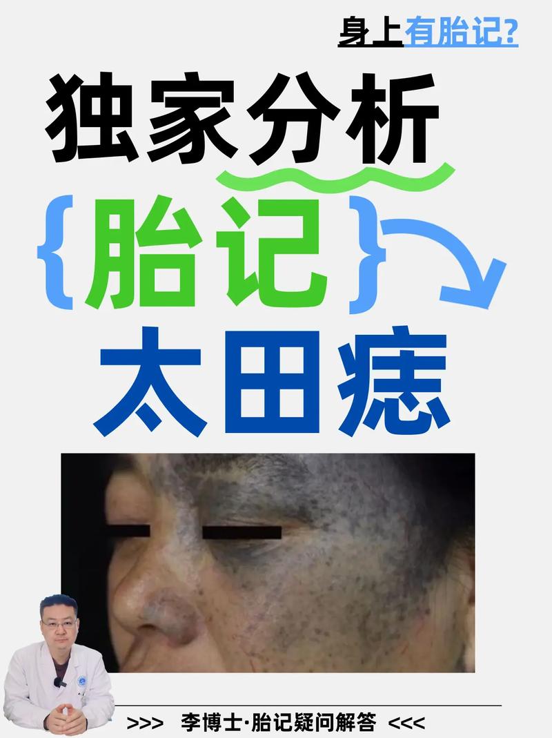 眼睛周围胎记代表什么命运？贵子胎记出现在六个部位有何特殊含义？