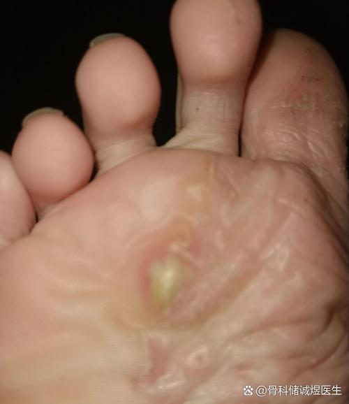 脚底流脓是否意味着居住地风水不佳？
