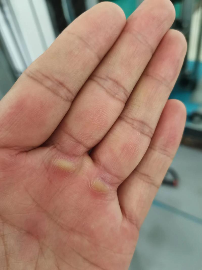 为什么我的手总是容易起茧子，这是命格使然吗？