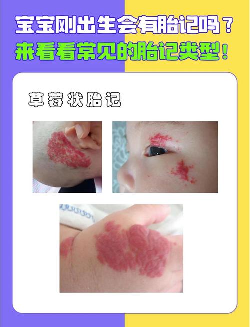 脸上胎记命运图解是什么意思？