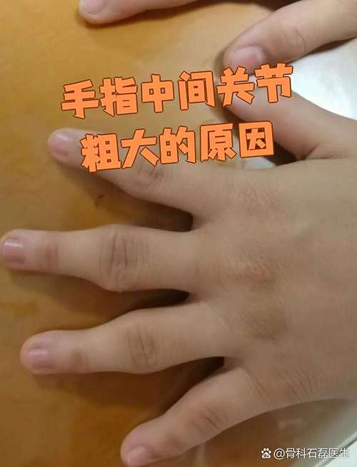 手指中间骨节细叫什么？男人手指骨节大是什么原因？
