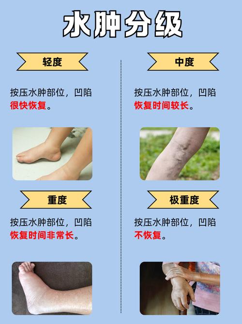 风水水肿是否包含在水肿的范畴之内？