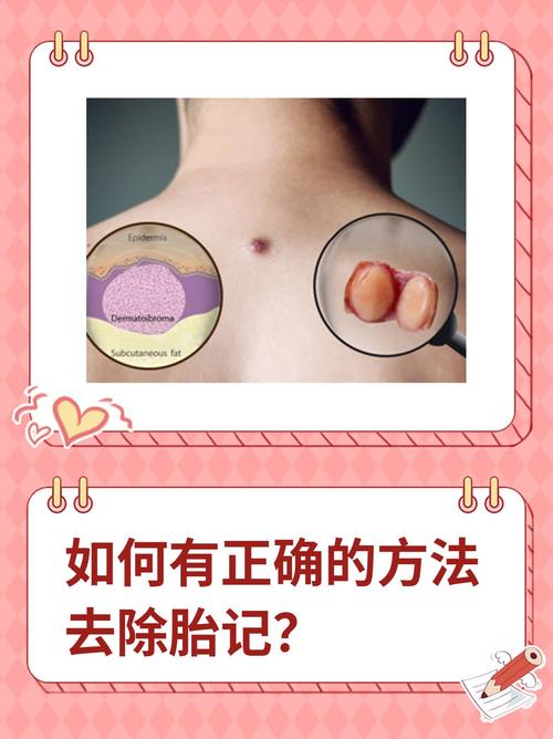 去除胎记对男孩的运势和风水有影响吗？