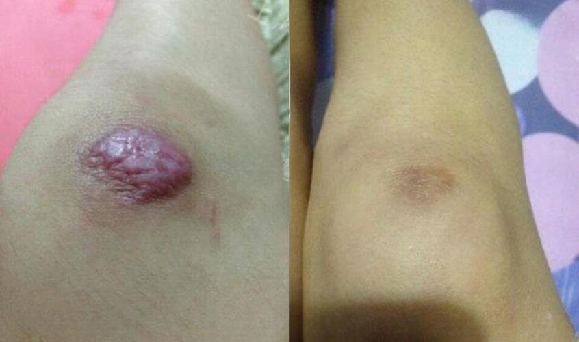 腿上膝盖疤痕会影响命格吗？这是否会改变我的命运走向？