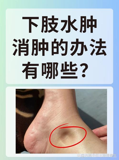 风水水肿是否包含在水肿的范畴之内？