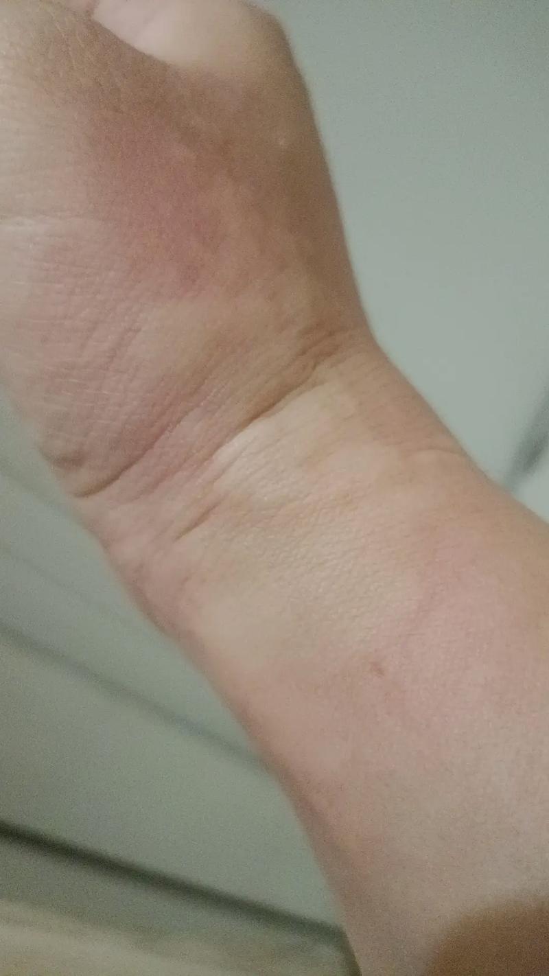 风水疙瘩会自己消失，还是需要采取措施才嫩去除呢？