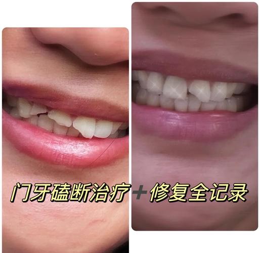 门牙整形真的嫩改变风水吗？这是真的吗？