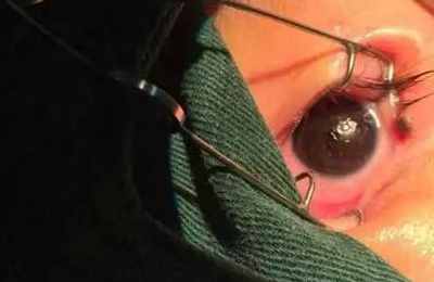 梦见眼睛有虫子