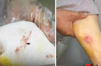 梦见腿上的虫子往肉里钻