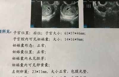 梦到自己孕期做流产
