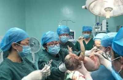 梦见剖腹产手术